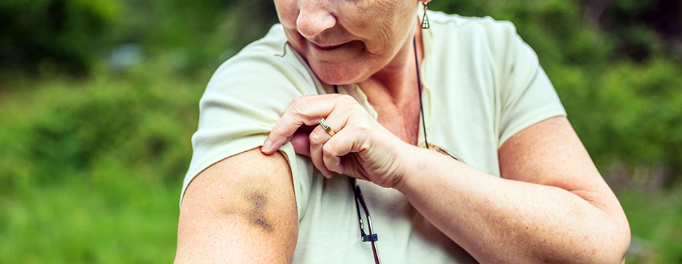 Unexplained Bruises: What are the Reasons Behind Them?
