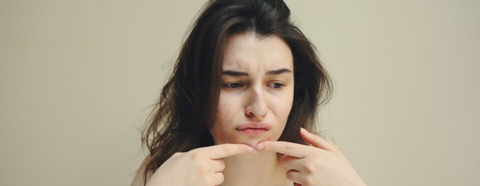 Best Creams For Acne And Pimple Removal
